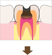 歯の神経（歯髄）まで虫歯になっている状態