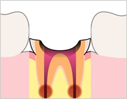 歯の根（歯根）の方まで虫歯になっている状態