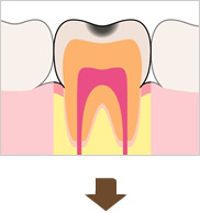エナメル質が虫歯になっている状態