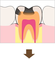 象牙質まで虫歯になっている状態