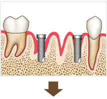 インプラント埋入手術（３０～１２０分）