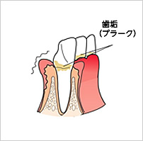 歯周病（軽度）